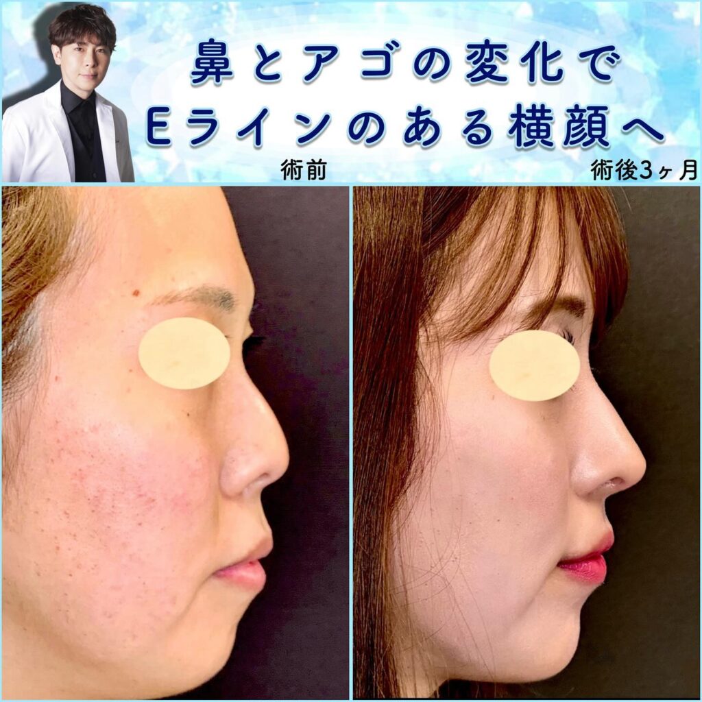 鼻尖形成と軟骨移植と鼻中隔延長と口角挙上と顎のヒアルロン酸の症例 (1)