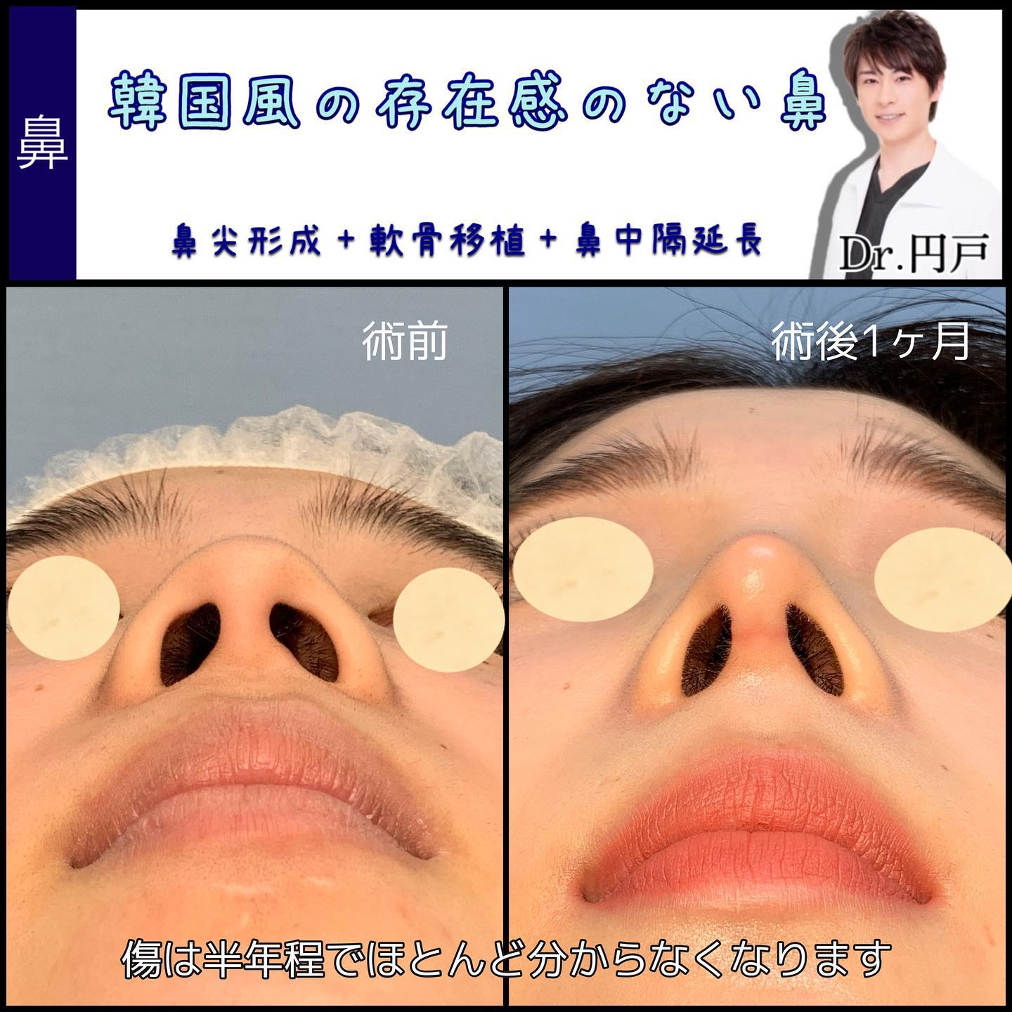 鼻尖形成と軟骨移植と鼻中隔延長の症例写真 (5)