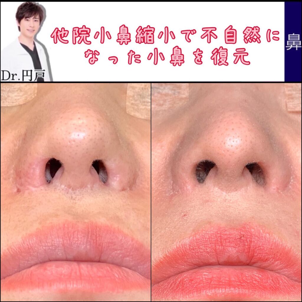 鼻翼拡大修正術の症例写真 (3)