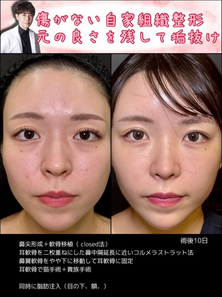 クローズド法の鼻尖形成と軟骨移植の症例写真 (2)