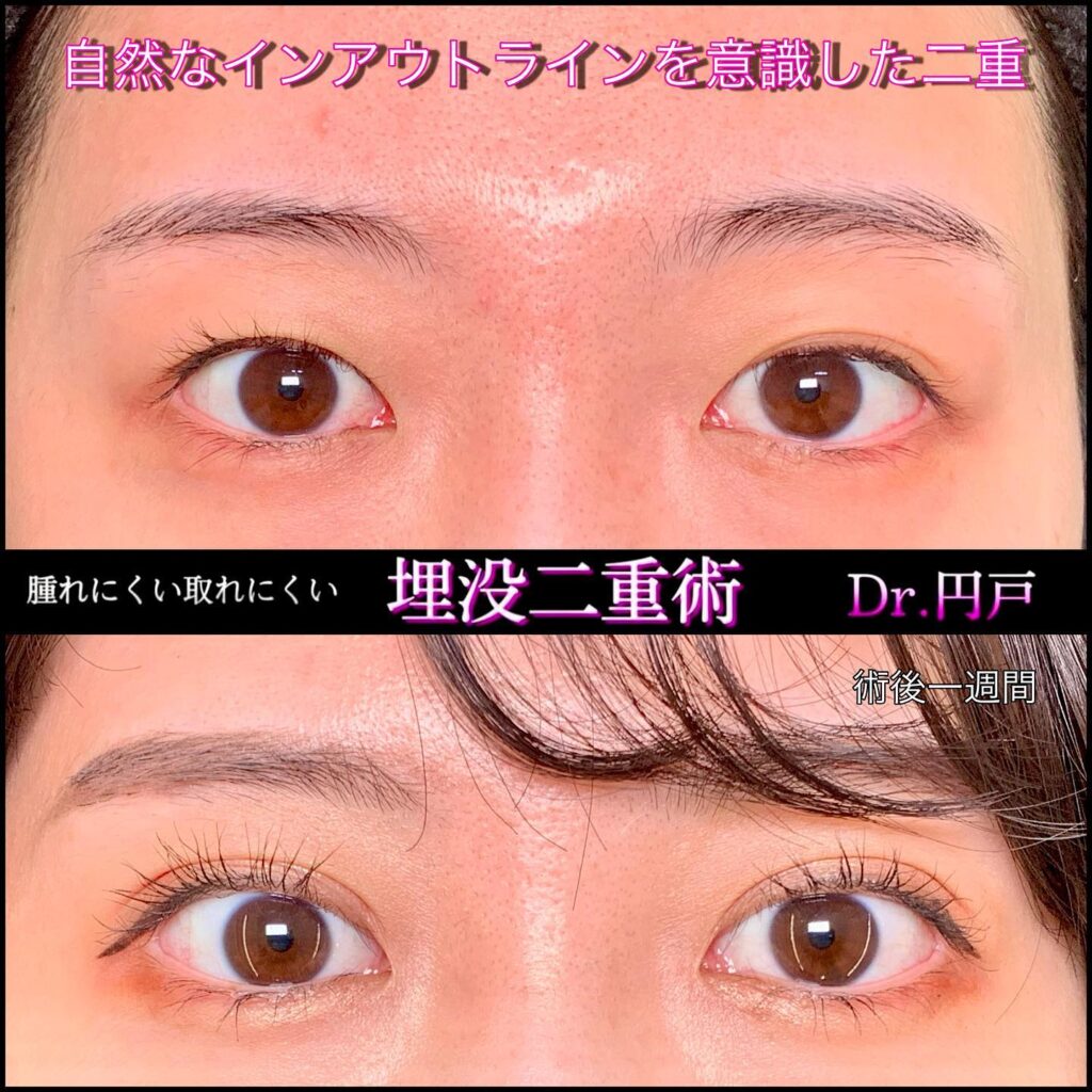 埋没法の症例写真 (25)