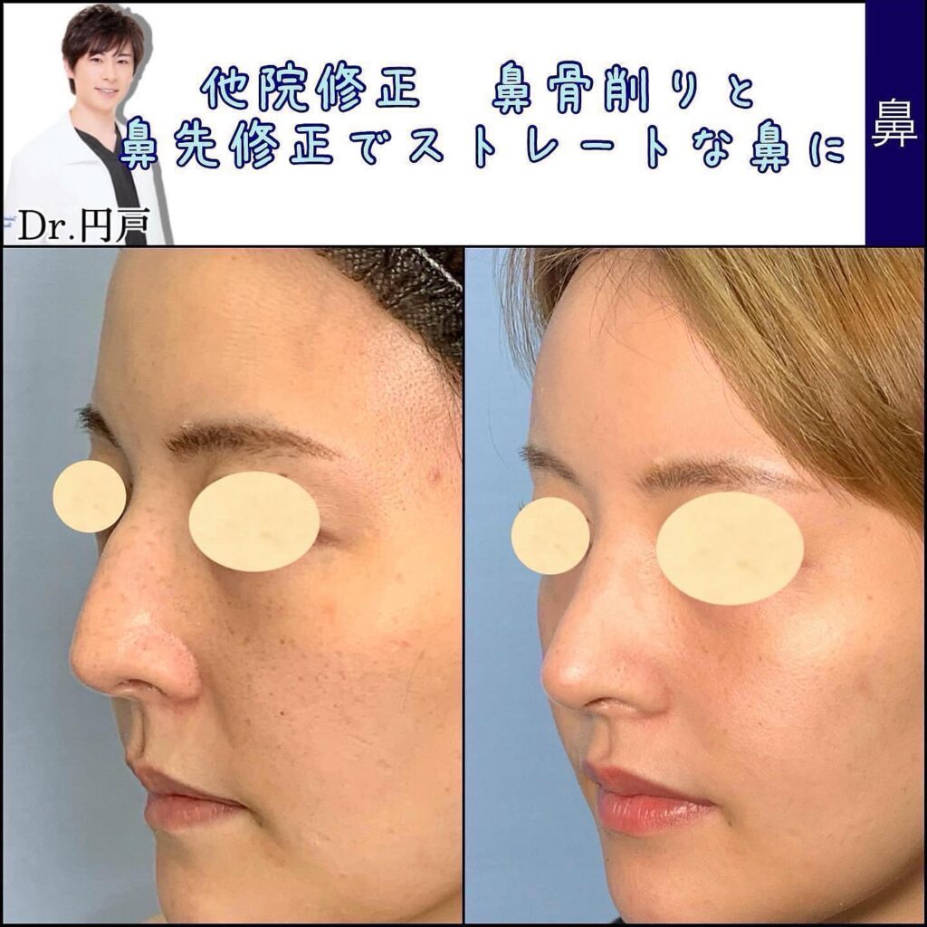 鼻の他院修正の症例写真 (5)