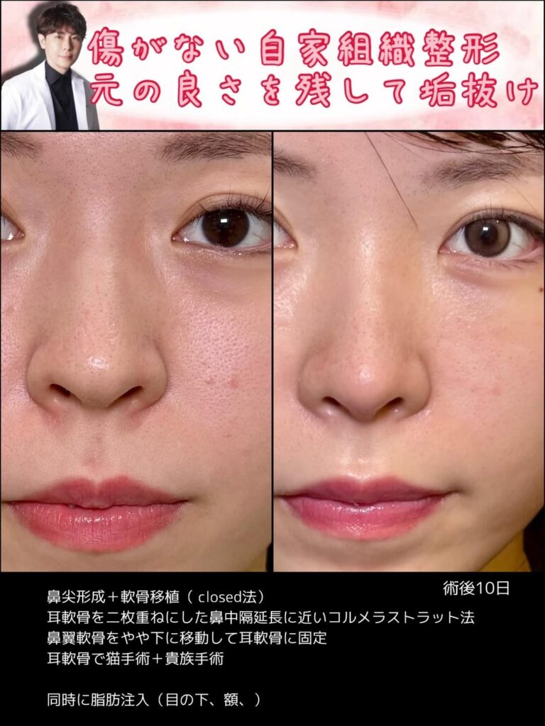 クローズド法の鼻尖形成と軟骨移植の症例写真 (1)