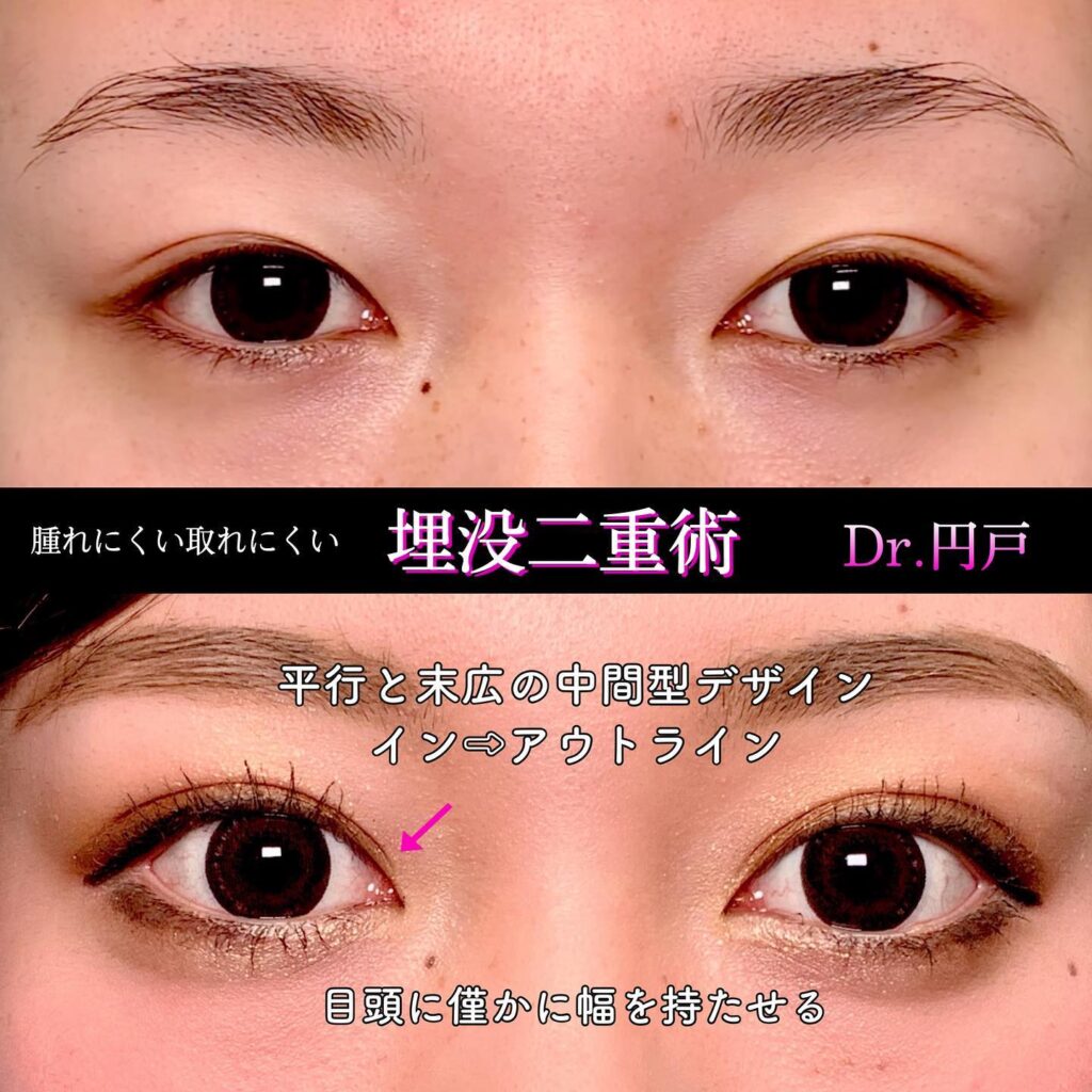 埋没法の症例写真 (16)