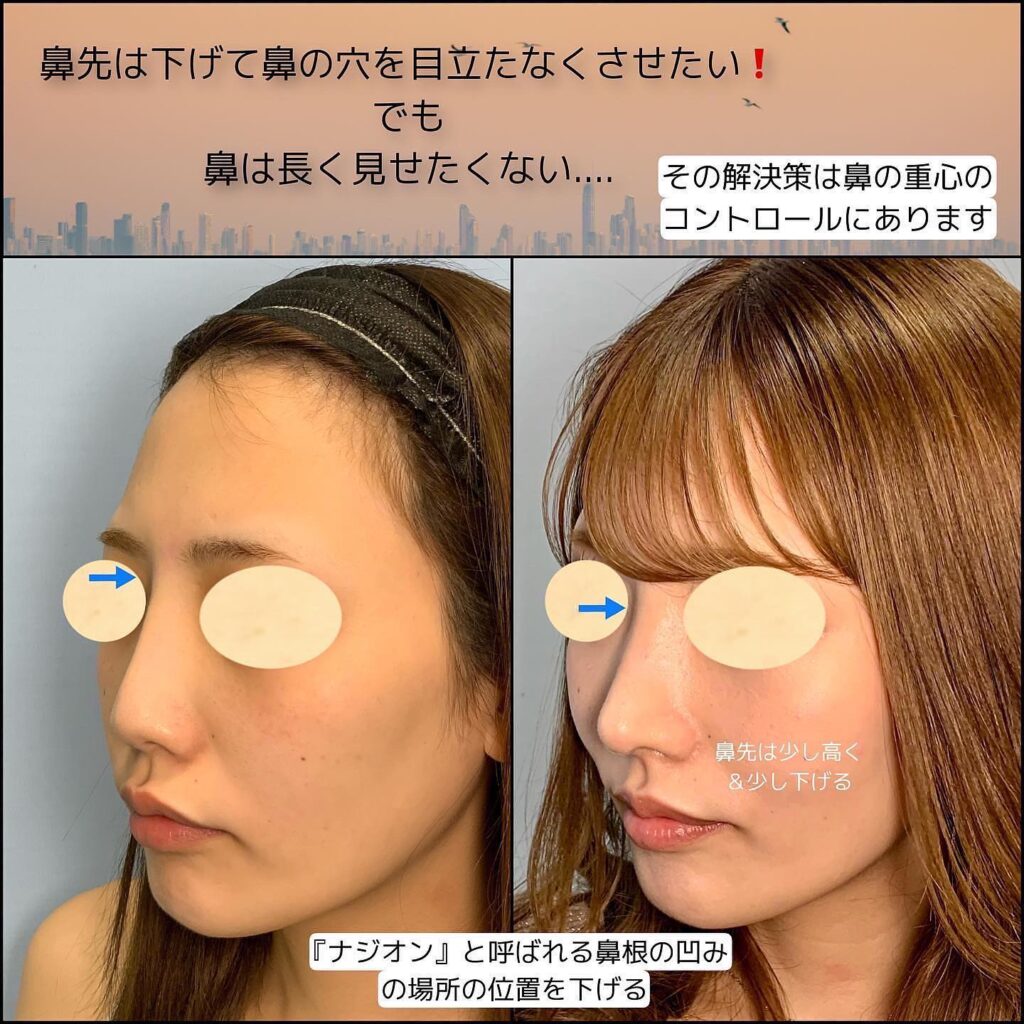 鼻の他院修正の症例写真 (1)