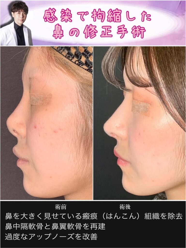 感染で拘縮した鼻を鼻中隔軟骨と鼻翼軟骨で再建した修正手術 (1)