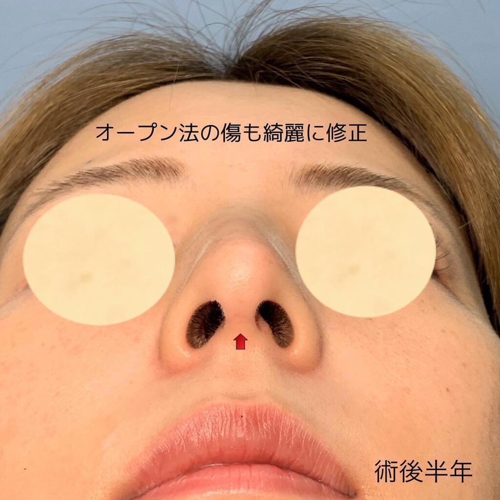 鼻の他院修正の症例写真 (4)