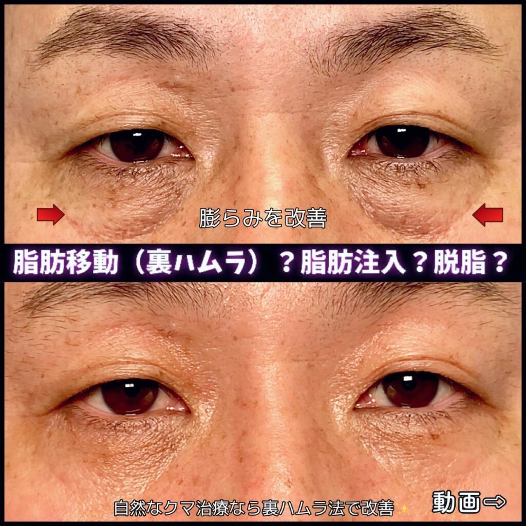 目の下のクマ取りの症例写真 (1)