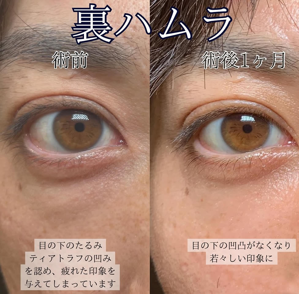 京都の男性のクマ取りの症例