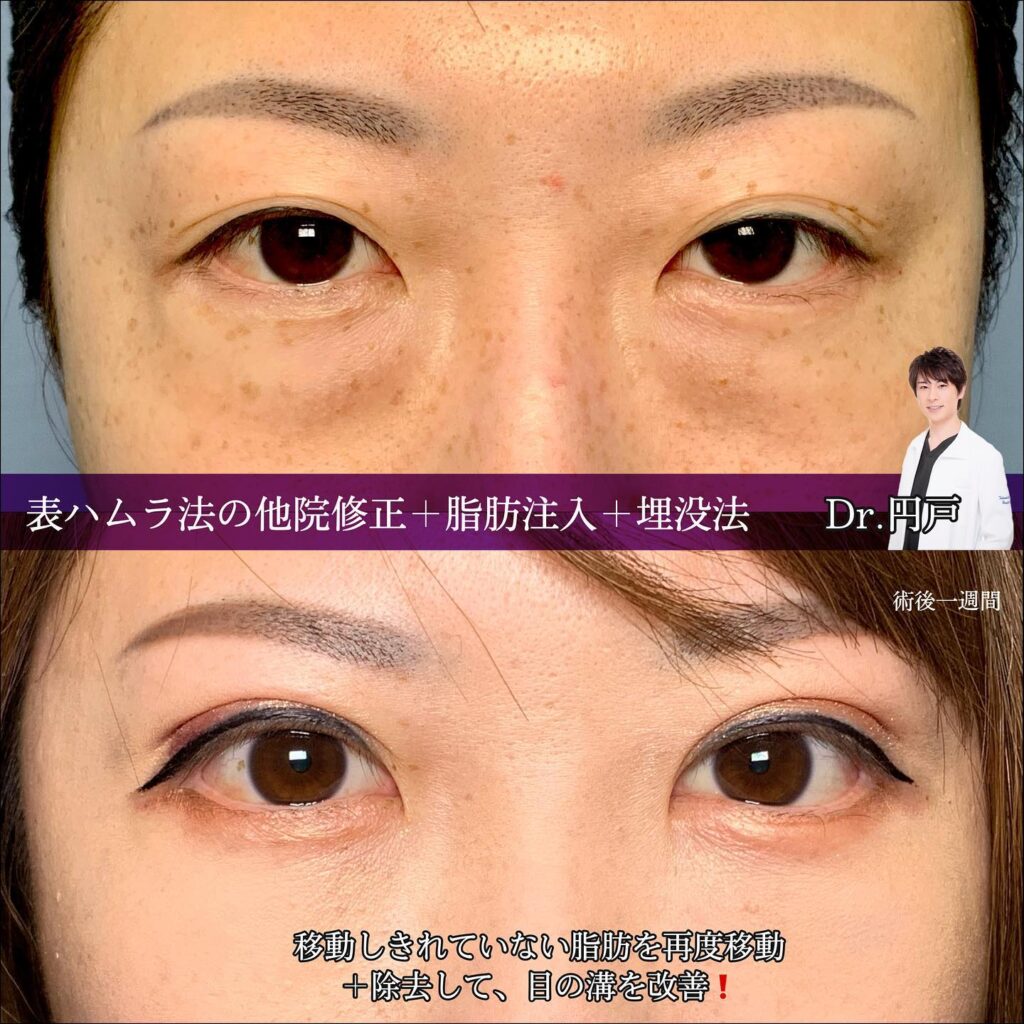 表ハムラ法の他院修正と脂肪注入と埋没法の症例写真 (1)