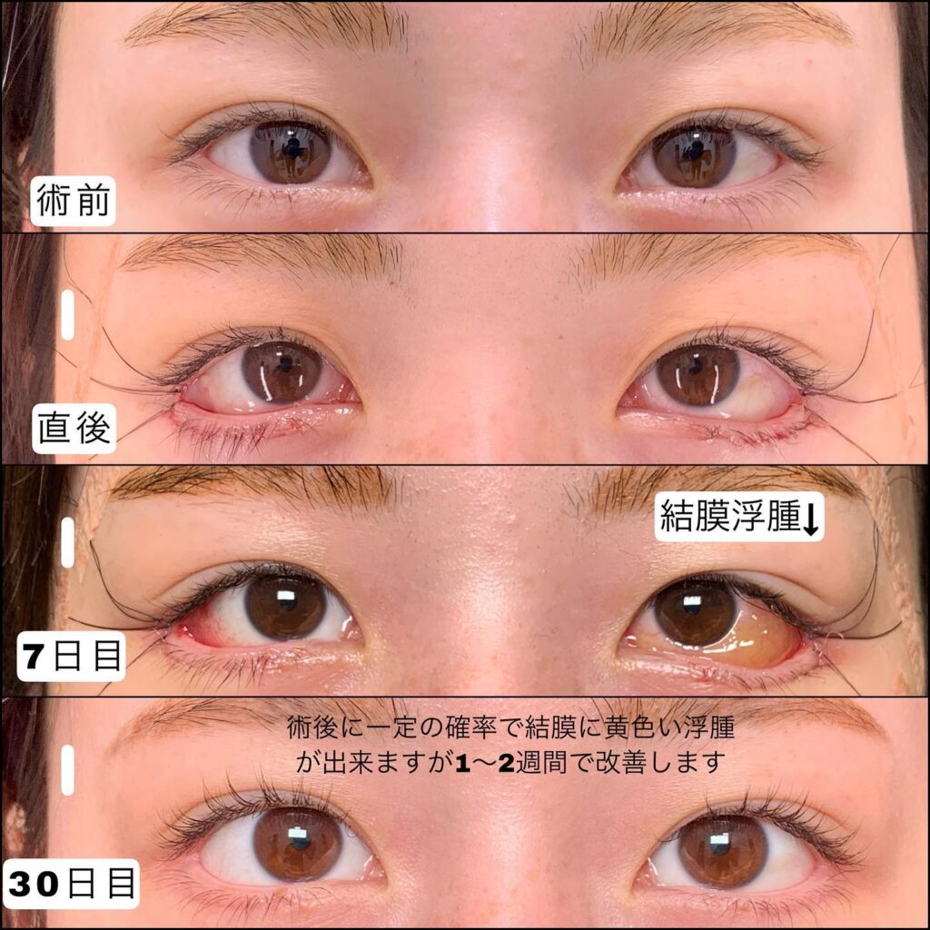 タレ目形成と目尻切開の症例写真 (3)