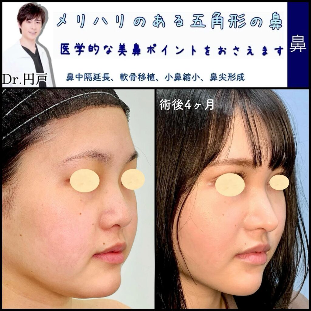 鼻中隔延長と軟骨移植と小鼻縮小と鼻尖形成症例写真 (1)