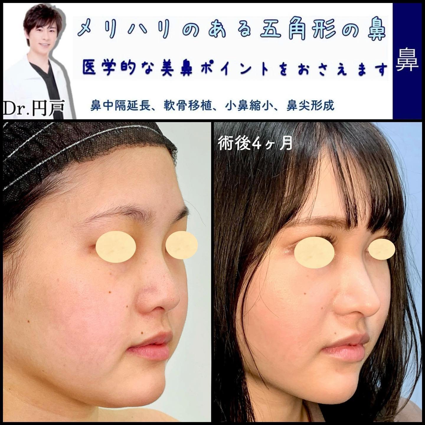 メリハリのある五角形の鼻 - eクリニック京都院【公式】｜京都の美容