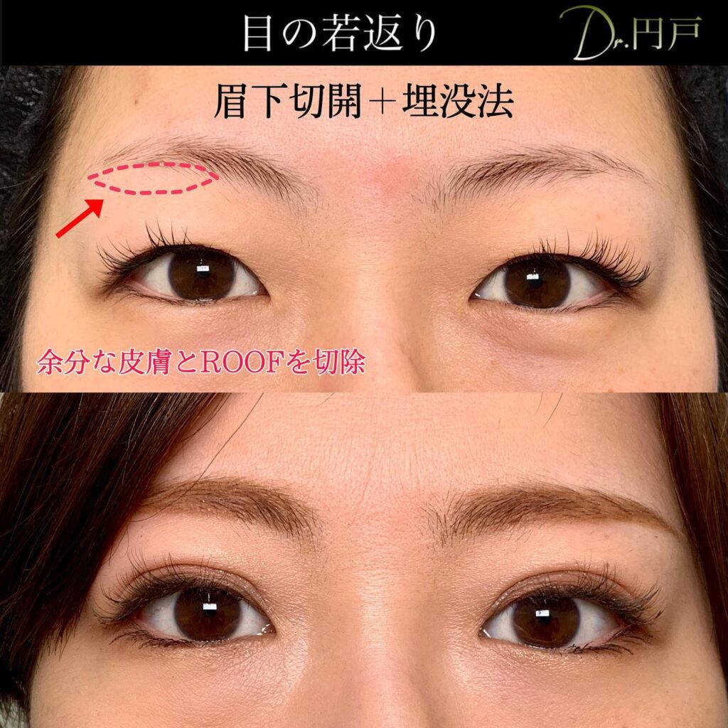眉下切開と眼瞼下垂の症例写真