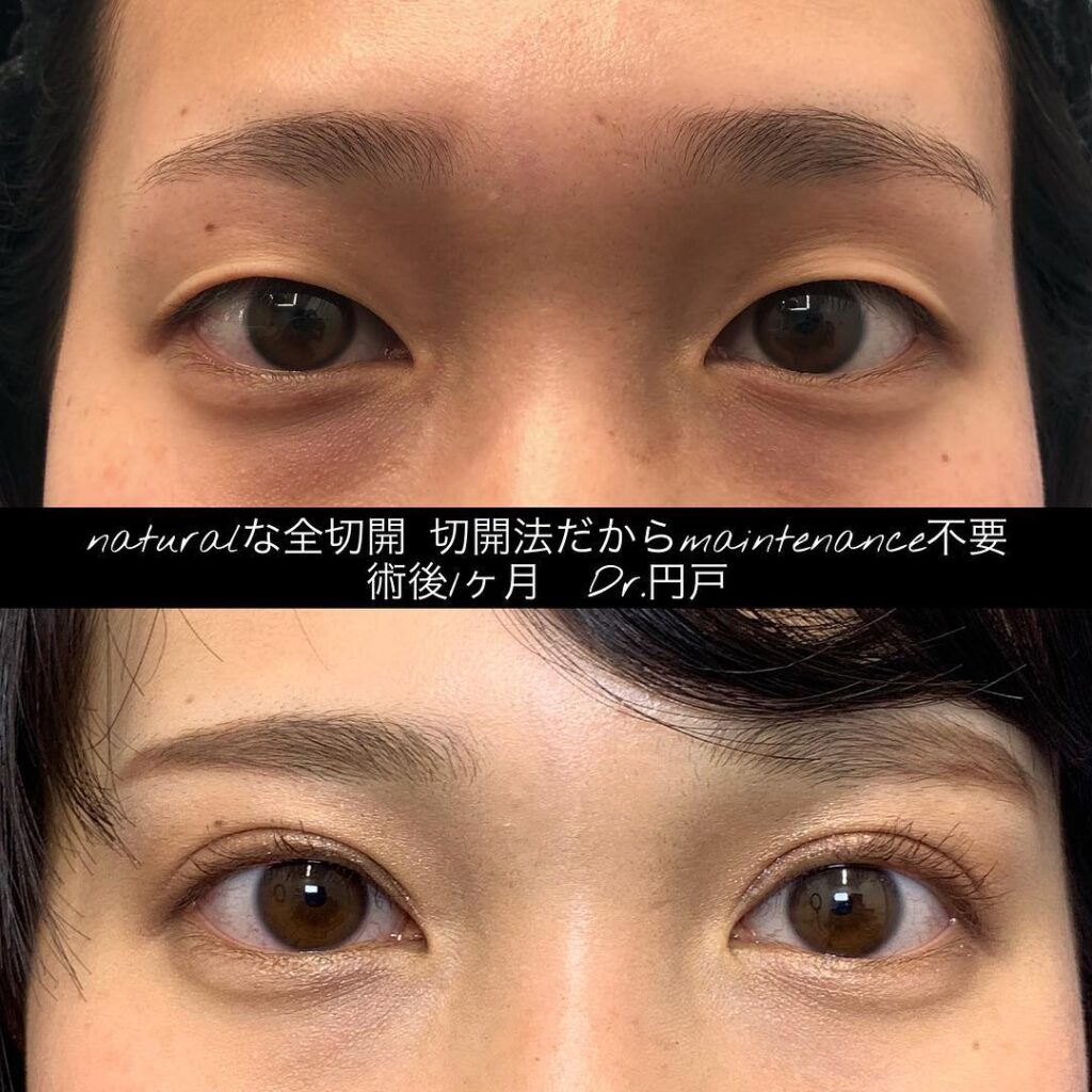 全切開の症例写真 (2)