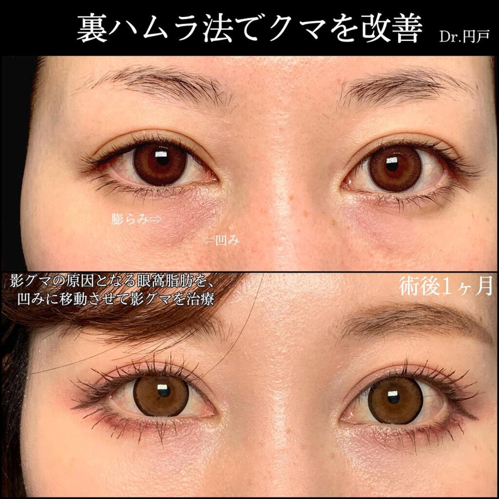 裏ハムラ法の症例写真 (11)