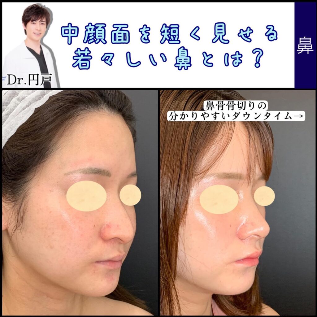 鼻骨骨切りの症例写真 (1)