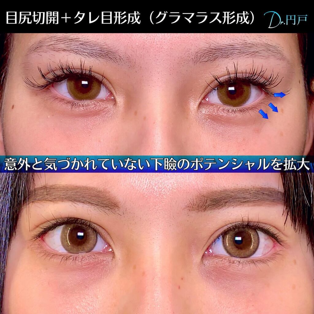 目尻切開とタレ目形成の症例写真 (6)