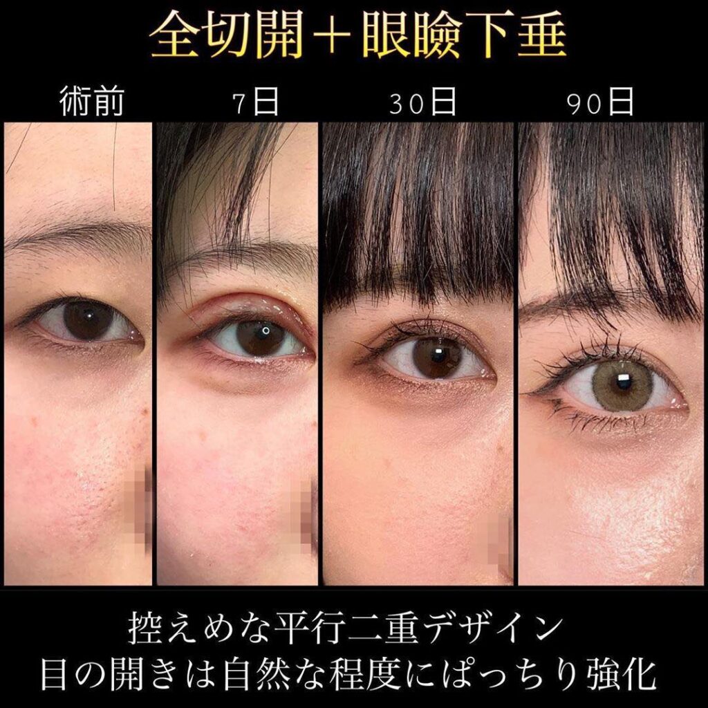 全切開と眼瞼下垂の経過の症例