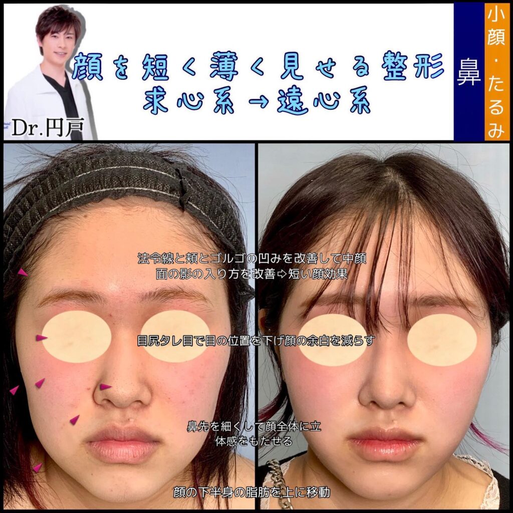 プロテーゼと鼻尖形成と軟骨移植と鼻中隔延長の症例写真 (4)