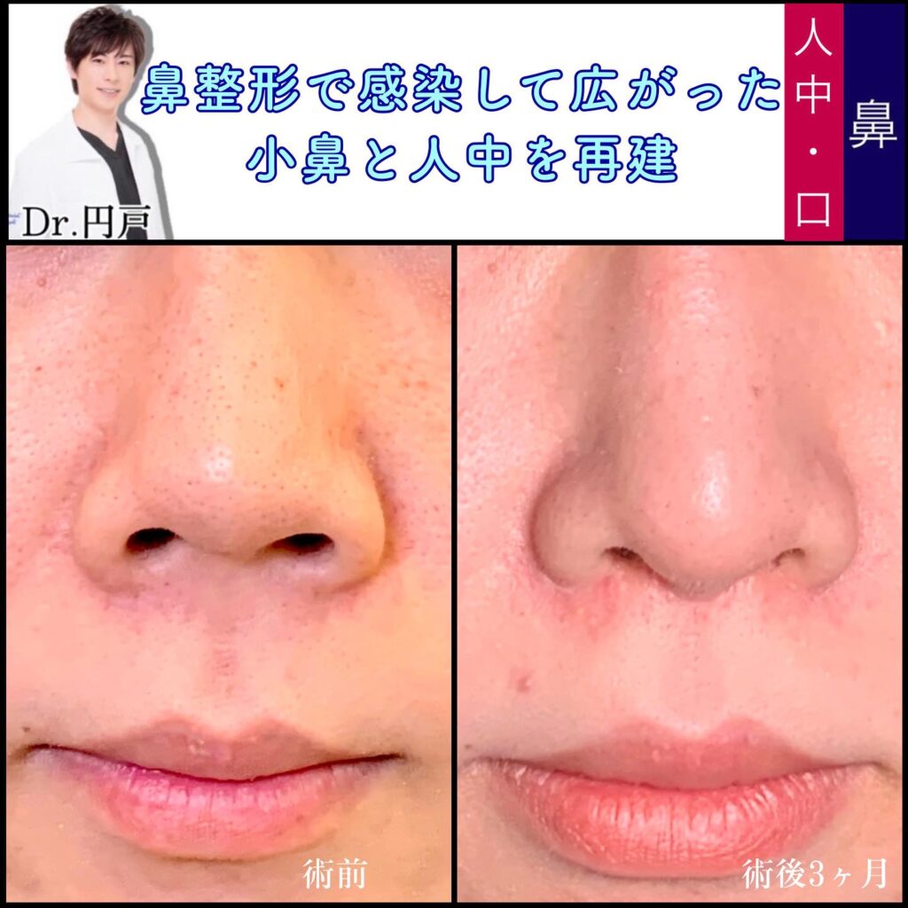 鼻と口の他院修正の症例写真 (3)