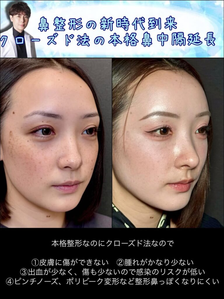 横から見た傷がない鼻中隔延長の症例写真 (1)