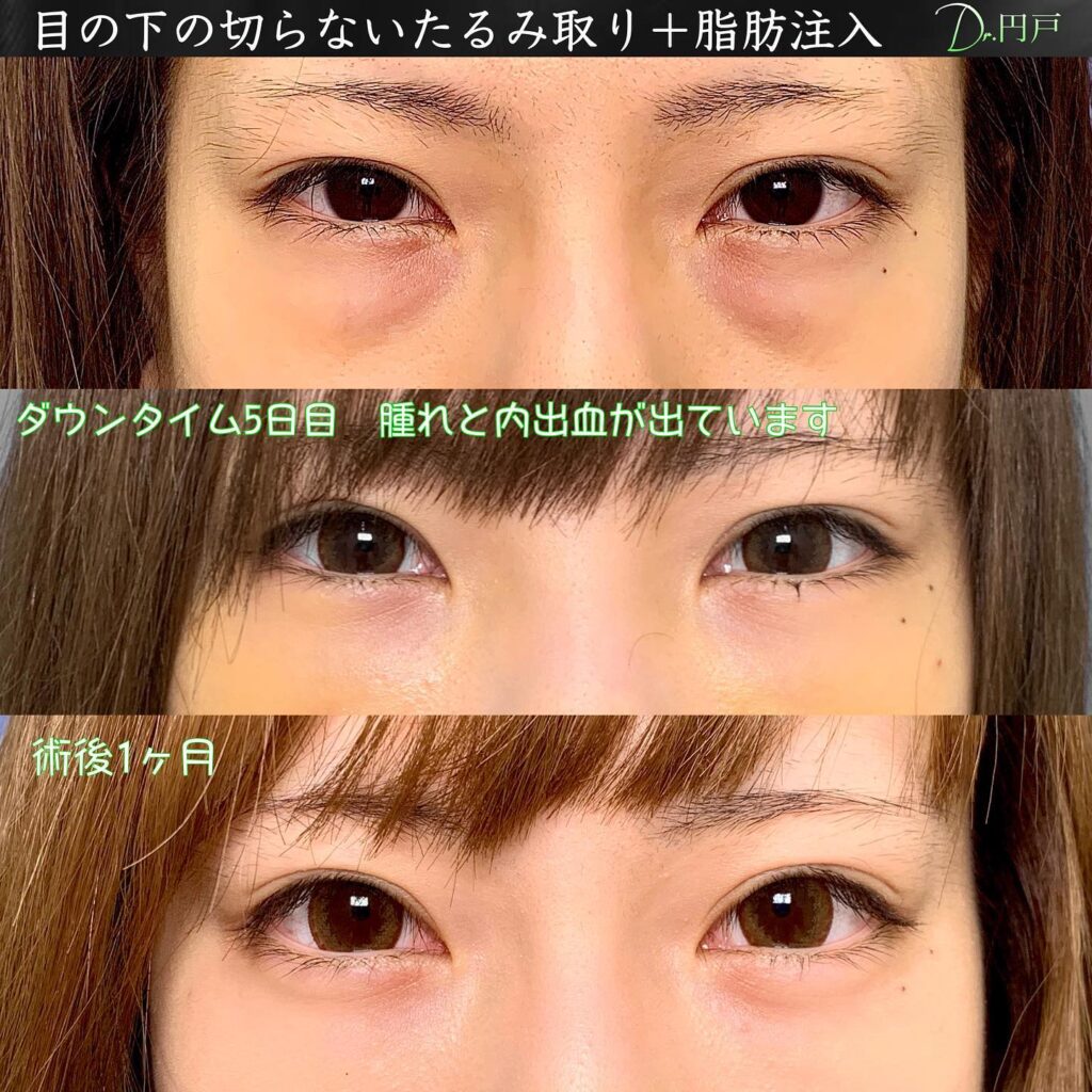 目の下の切らないたるみ取りと脂肪注入の症例写真 (3)