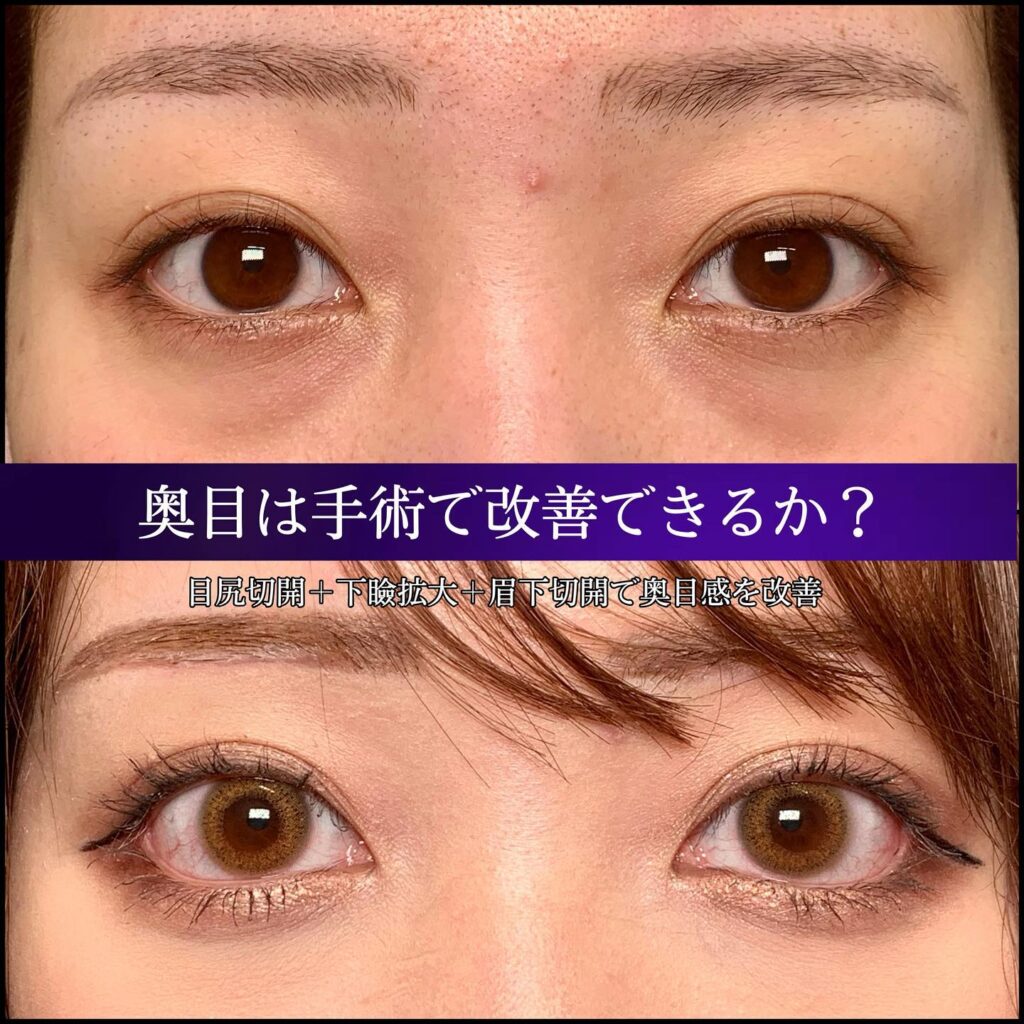 目尻切開とタレ目形成と眉下切開の症例写真 (3)