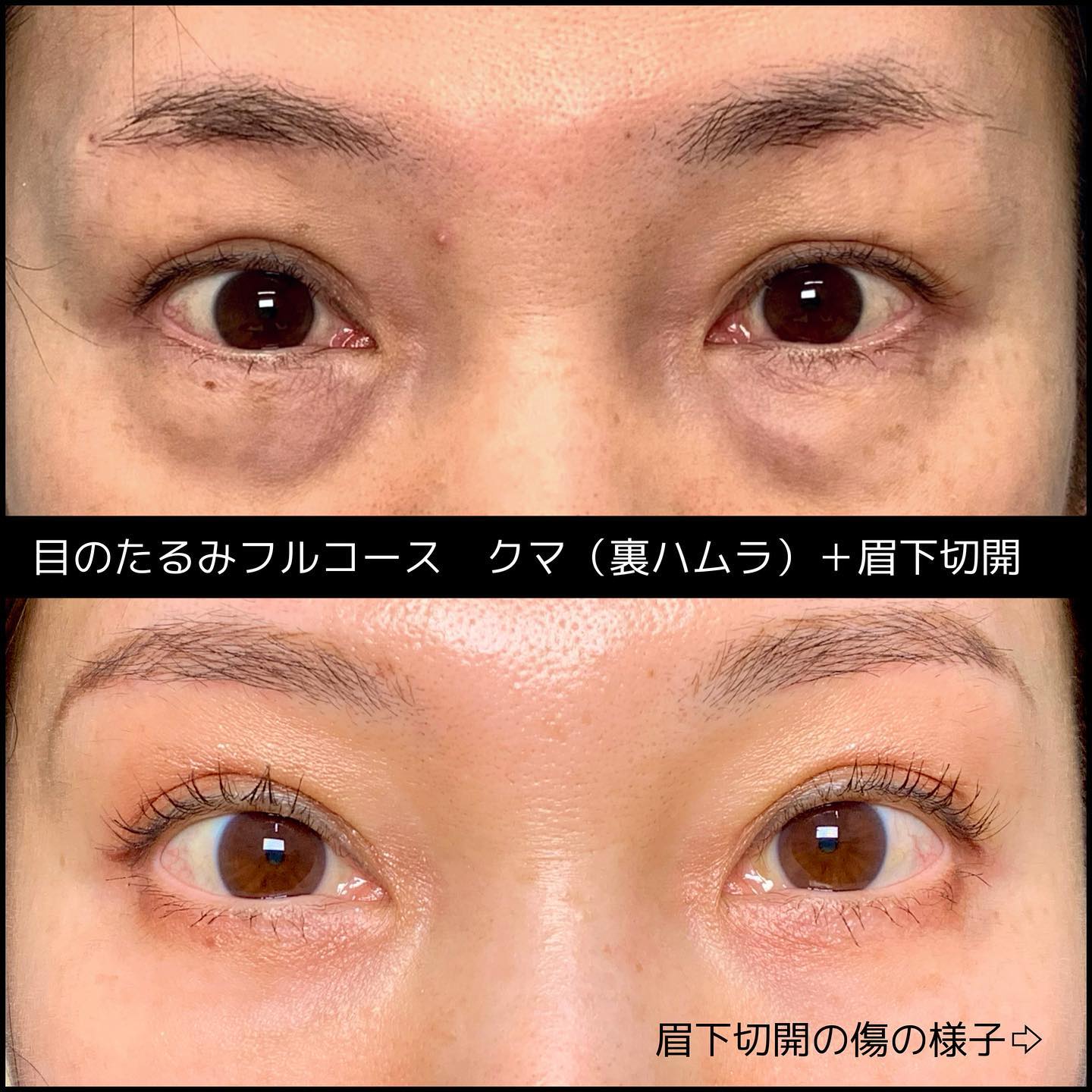 裏ハムラ法と眉下切開の症例写真