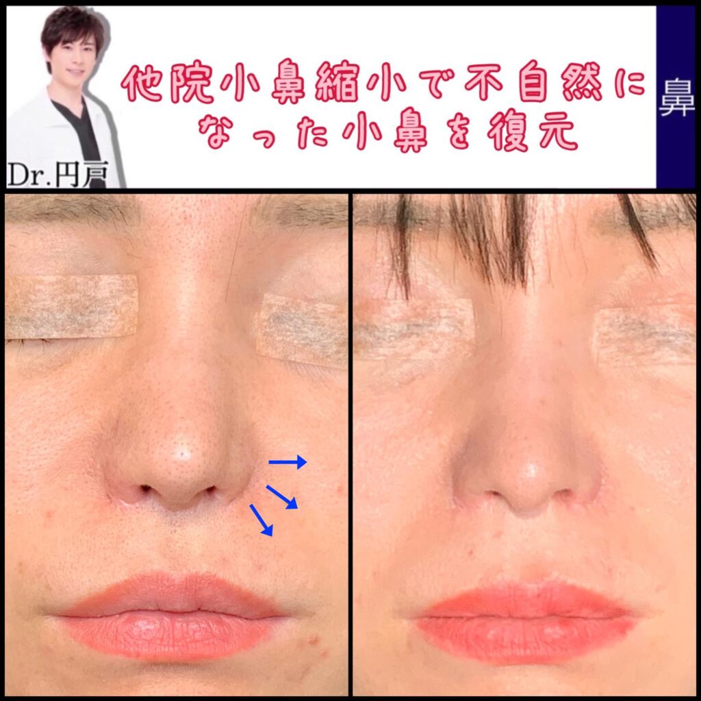 鼻翼拡大修正術の症例写真 (4)