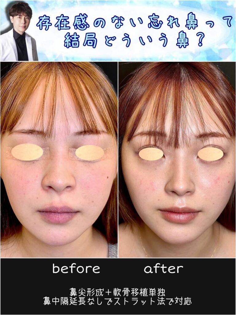 鼻尖形成と軟骨移植単独の症例写真 (1)