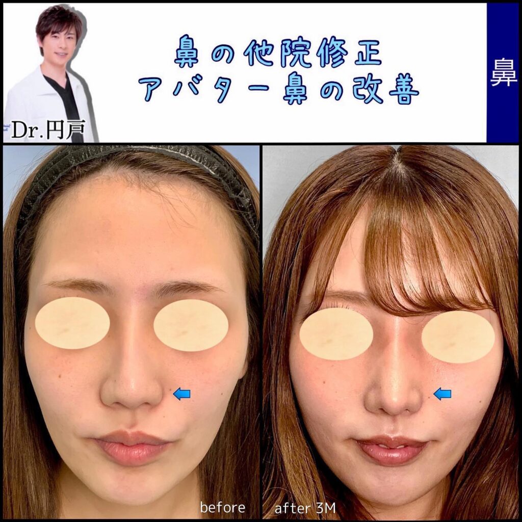 鼻の他院修正の症例写真 (3)