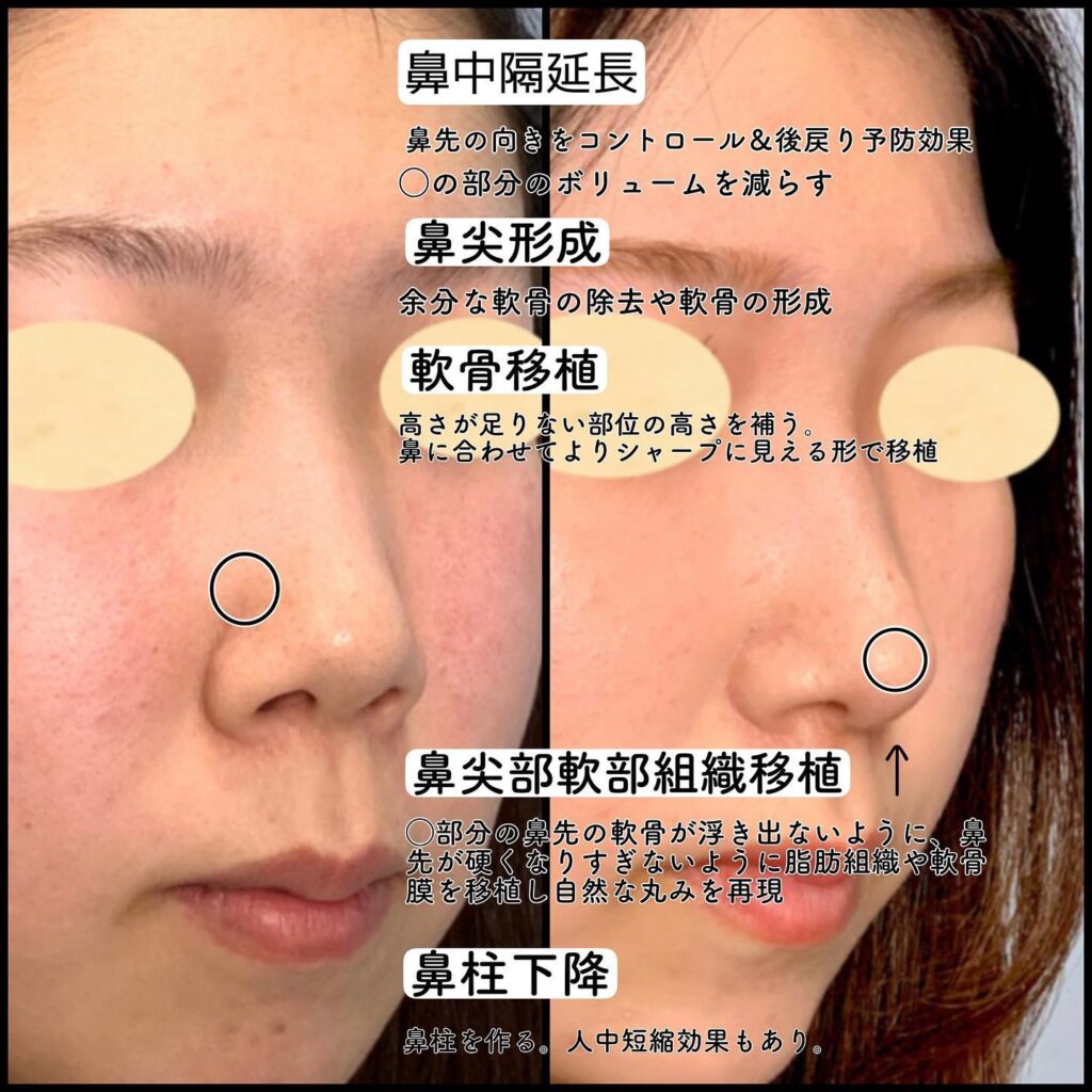 鼻中隔延長と軟骨移植とプロテーゼと脂肪注入と輪郭形成の症例写真 (1)