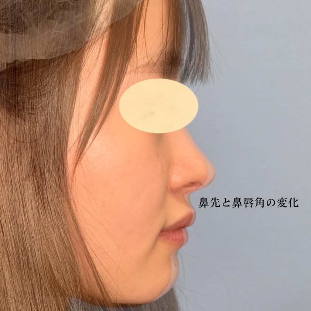 鼻唇角形成術の症例写真 (4)