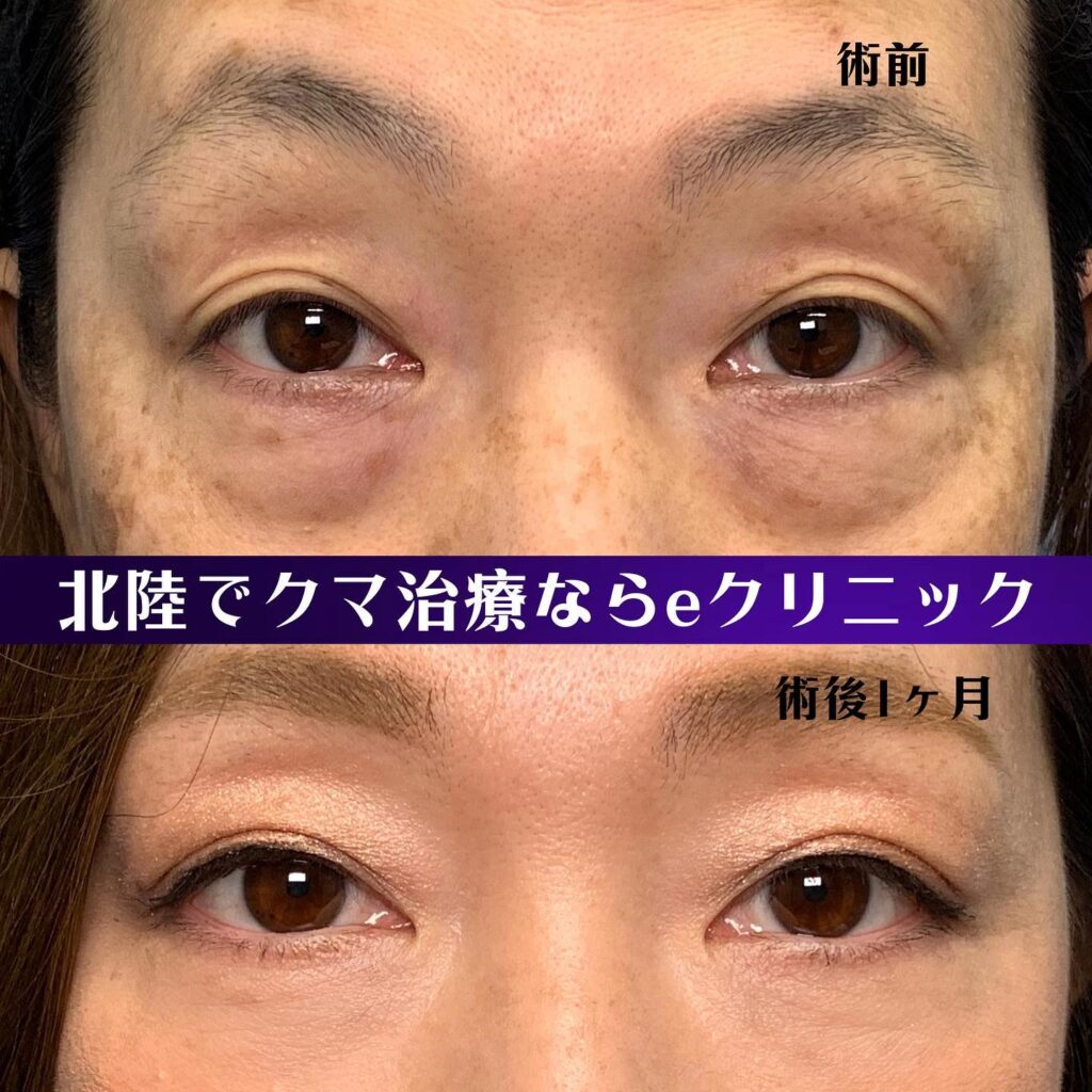 裏ハムラ法の症例写真 (12)