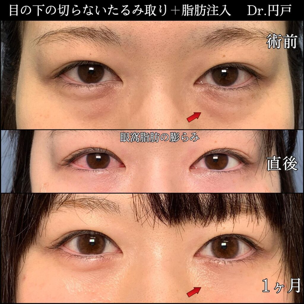 目の下の切らないたるみ取りと脂肪注入の症例写真 (2)
