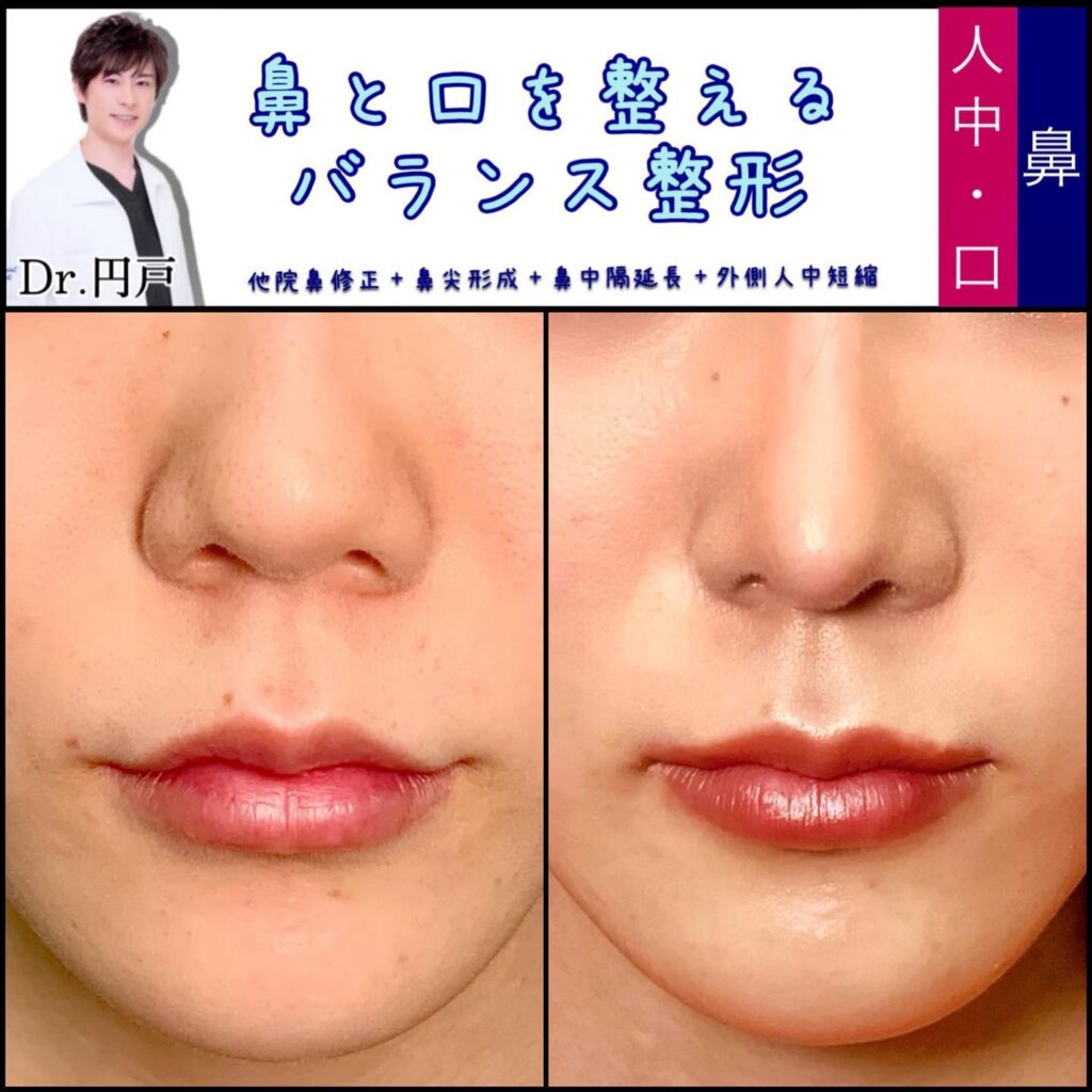 他院の鼻整形と鼻尖形成と鼻中隔延長と外側人中短縮の症例写真 (2)