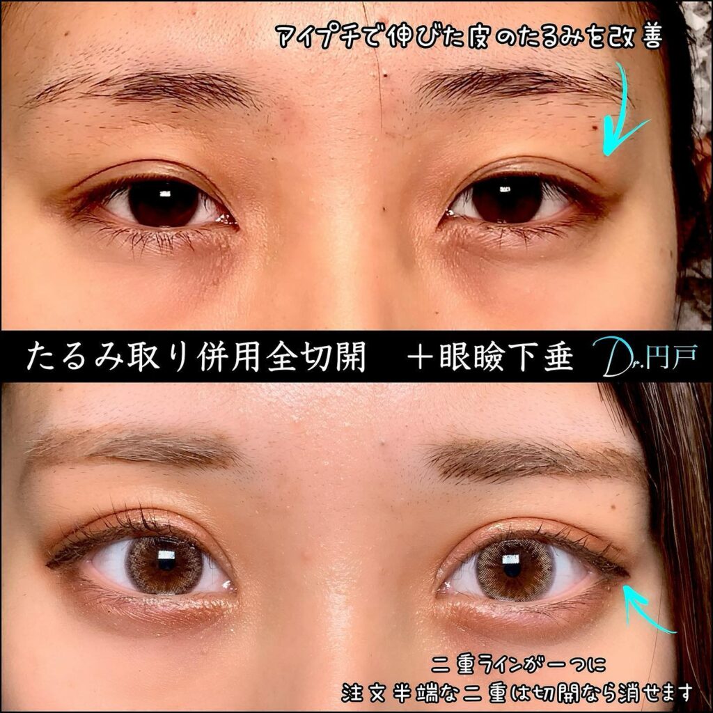 たるみ取り併用全切開と眼瞼下垂症例写真