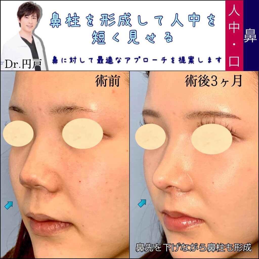 鼻中隔延長と軟骨移植と鼻尖形成と鼻柱下降の症例写真