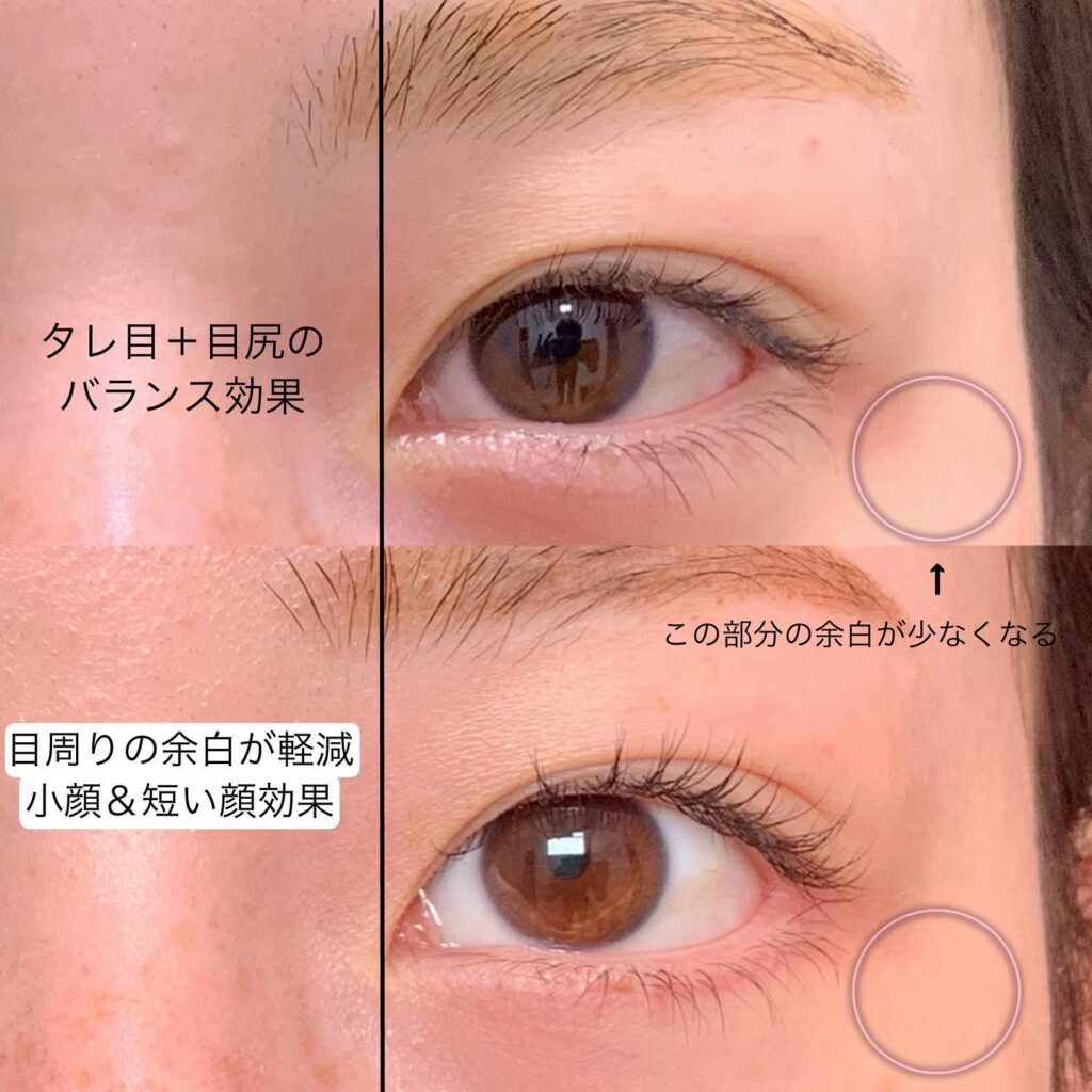 タレ目形成と目尻切開の症例写真 (5)