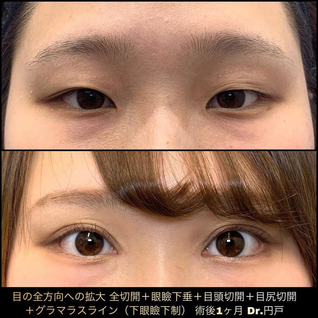 全切開と眼瞼下垂と目頭切開と目尻切開とタレ目形成の症例写真 (2)