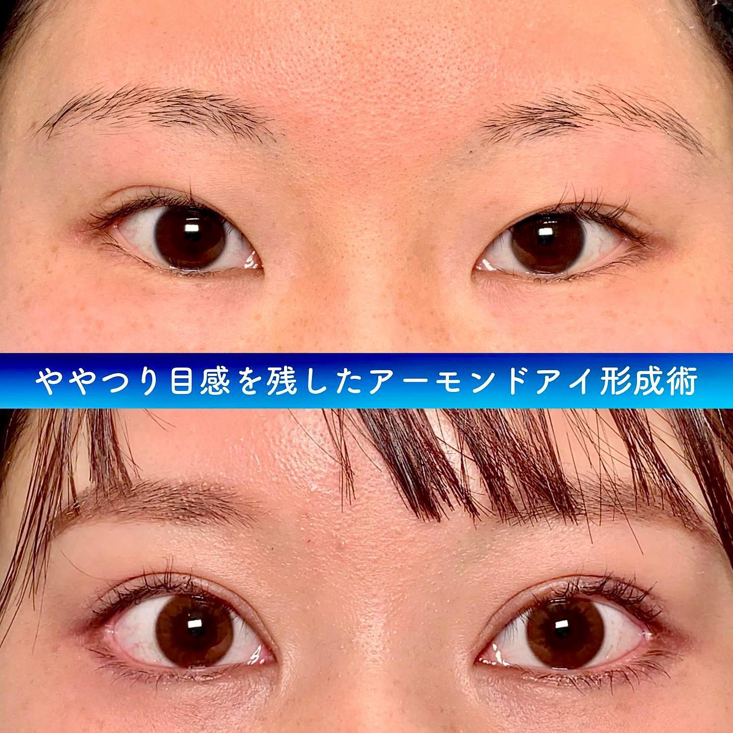 眼瞼下垂と全切開の症例写真