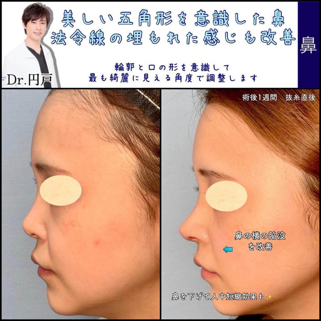 鼻尖形成で少し短い鼻を微妙に長くした症例写真 (3)