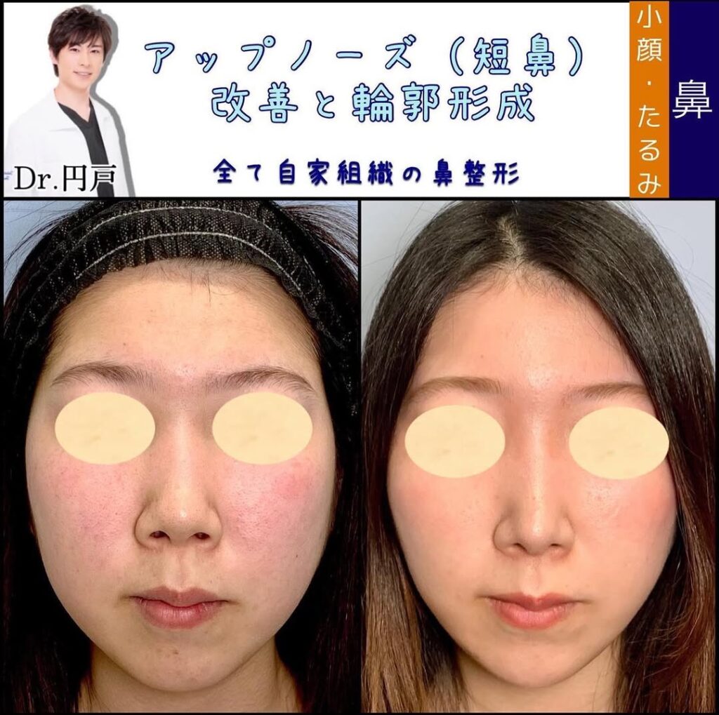 鼻中隔延長と美廃部軟骨移植と鼻尖形成と軟骨移植と輪郭形成と顎のヒアルロン酸の症例写真 (2)