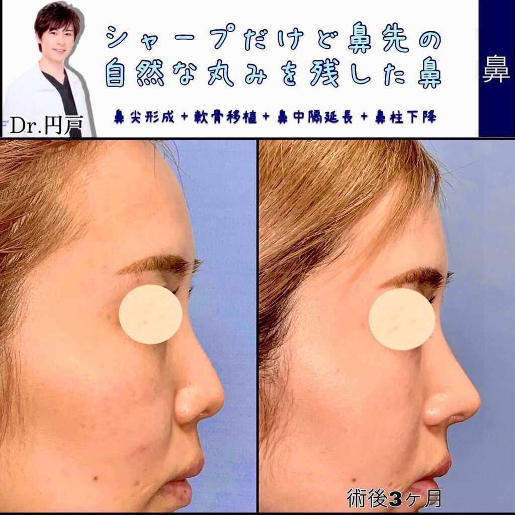 鼻尖形成と軟骨移植と鼻中隔延長と鼻柱下降の症例写真 (3)