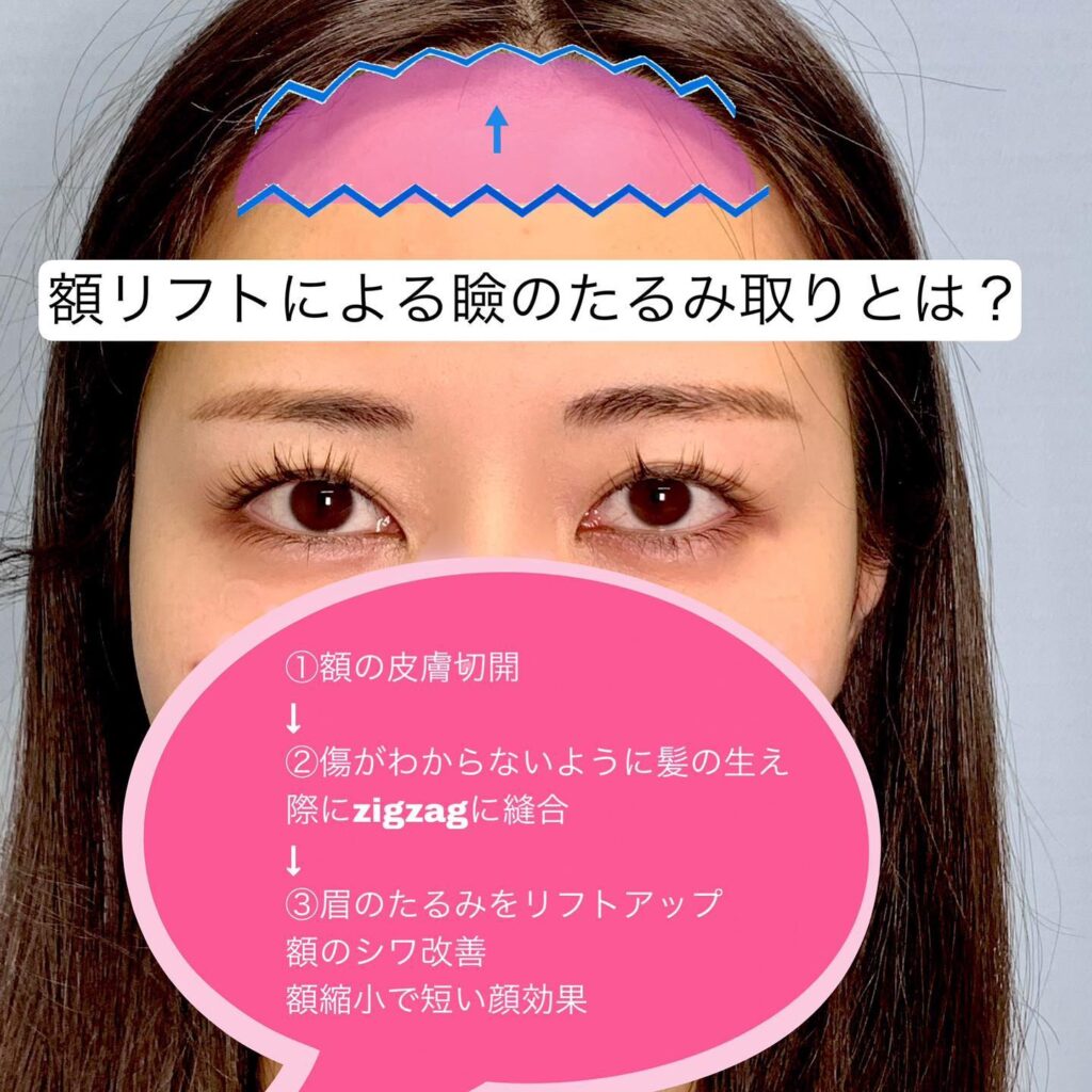 額リフトの症例写真 (1)