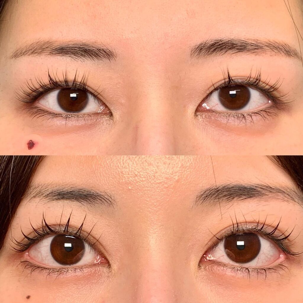 額リフトの症例写真 (1)