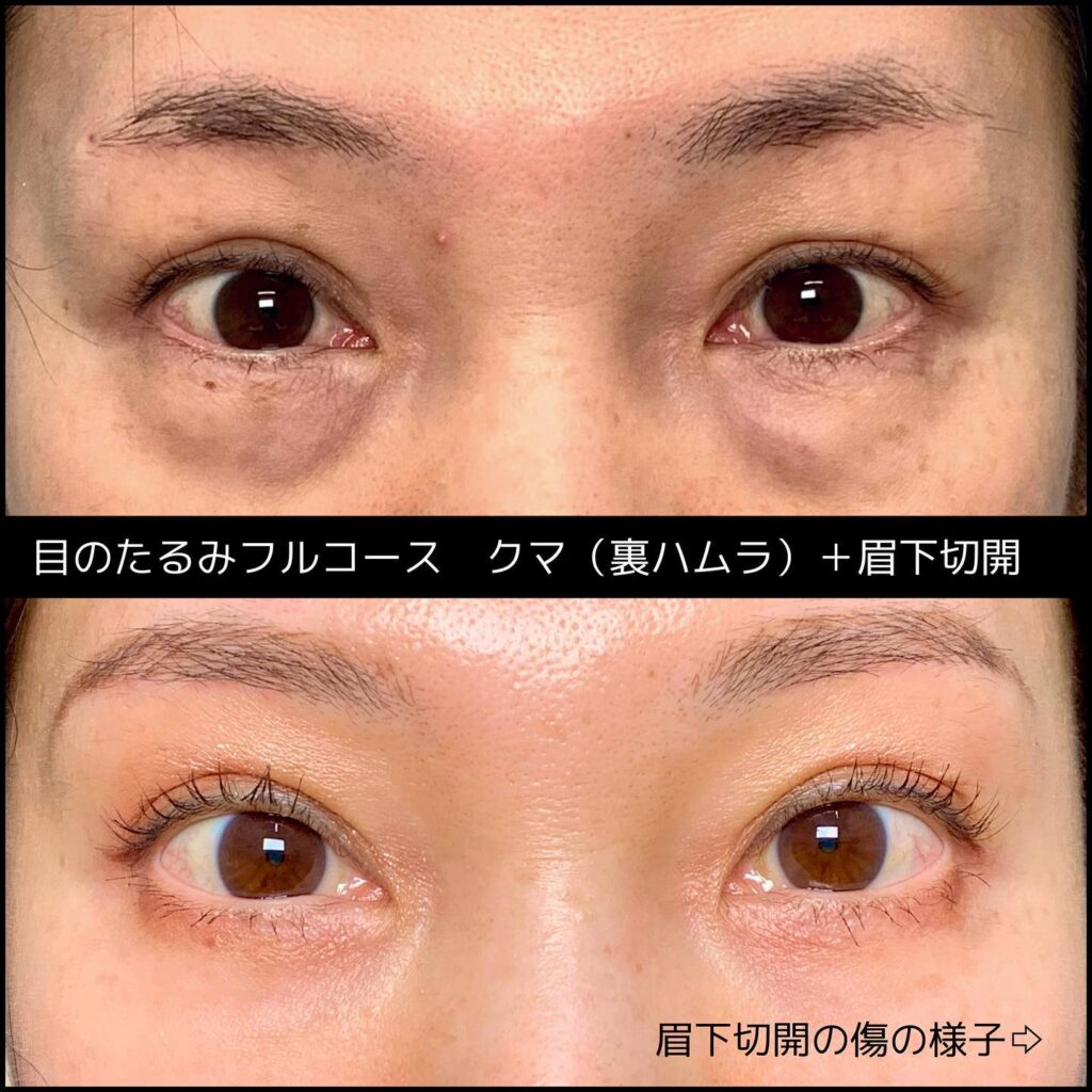 裏ハムラ法と眉下切開の症例写真 (2)