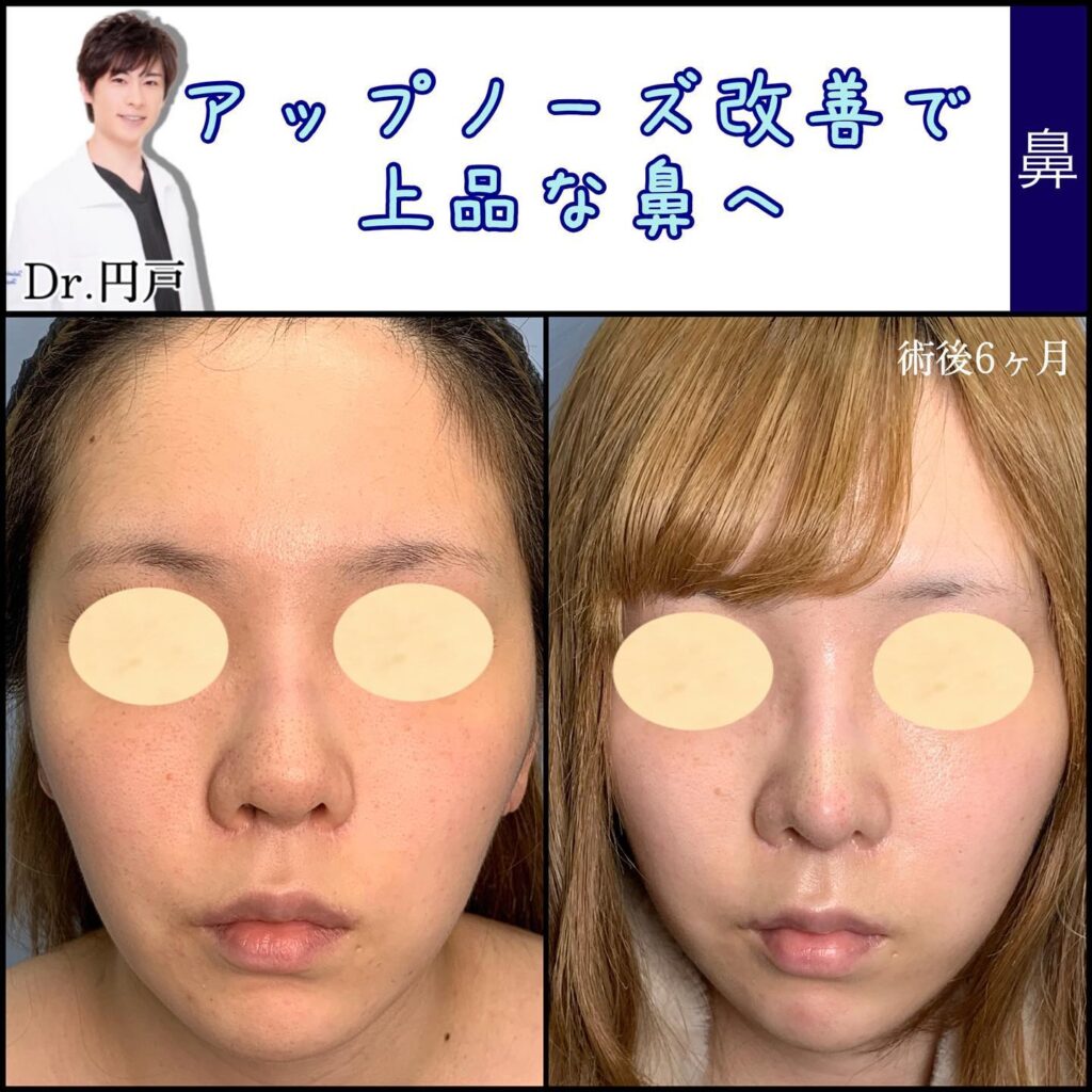 鼻中隔延長の症例写真 (6)