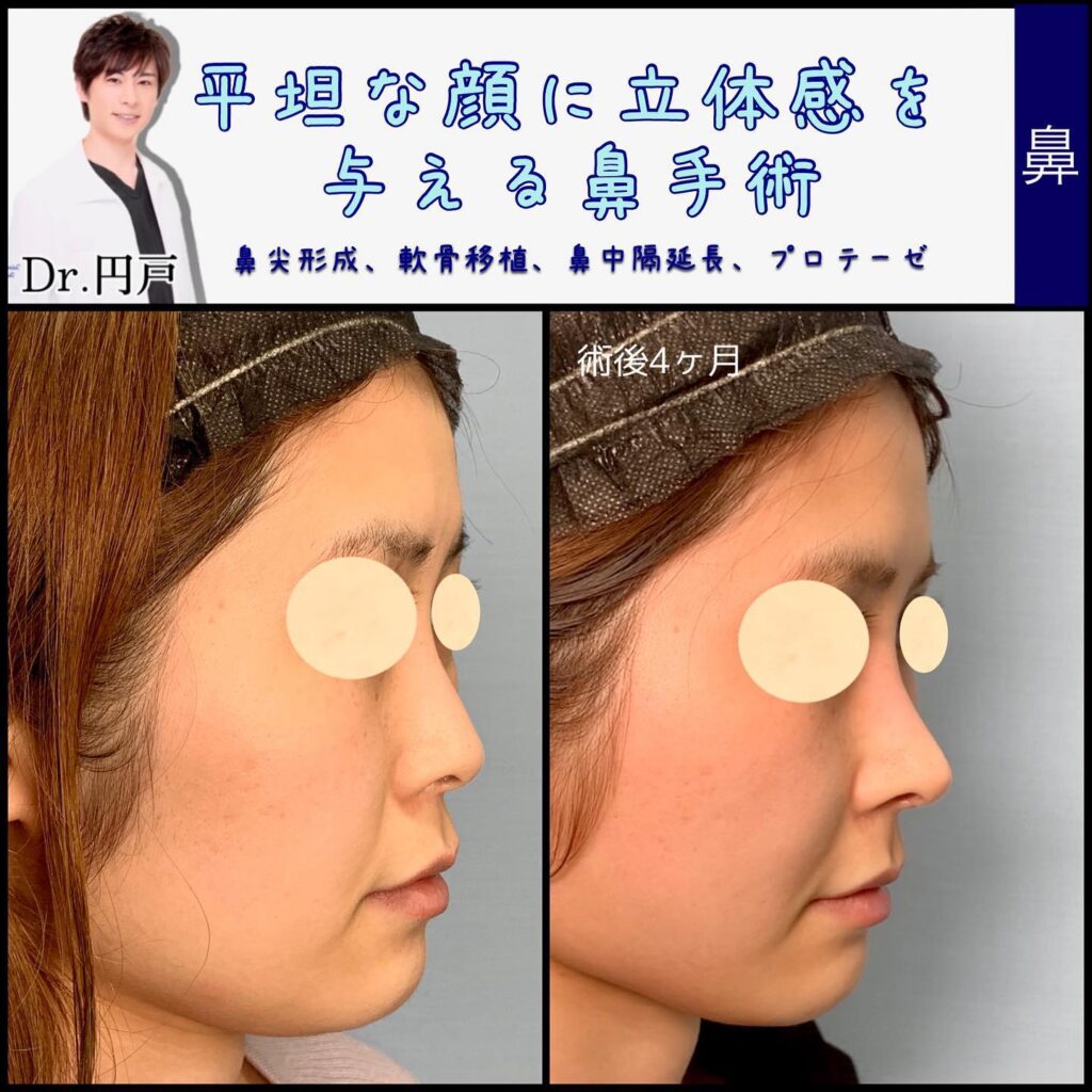 鼻尖形成と軟骨移植と鼻中隔延長とプロテーゼの症例写真